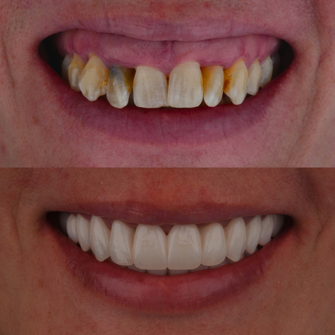 Before and after FP1 hybrid dentures full smile restoration